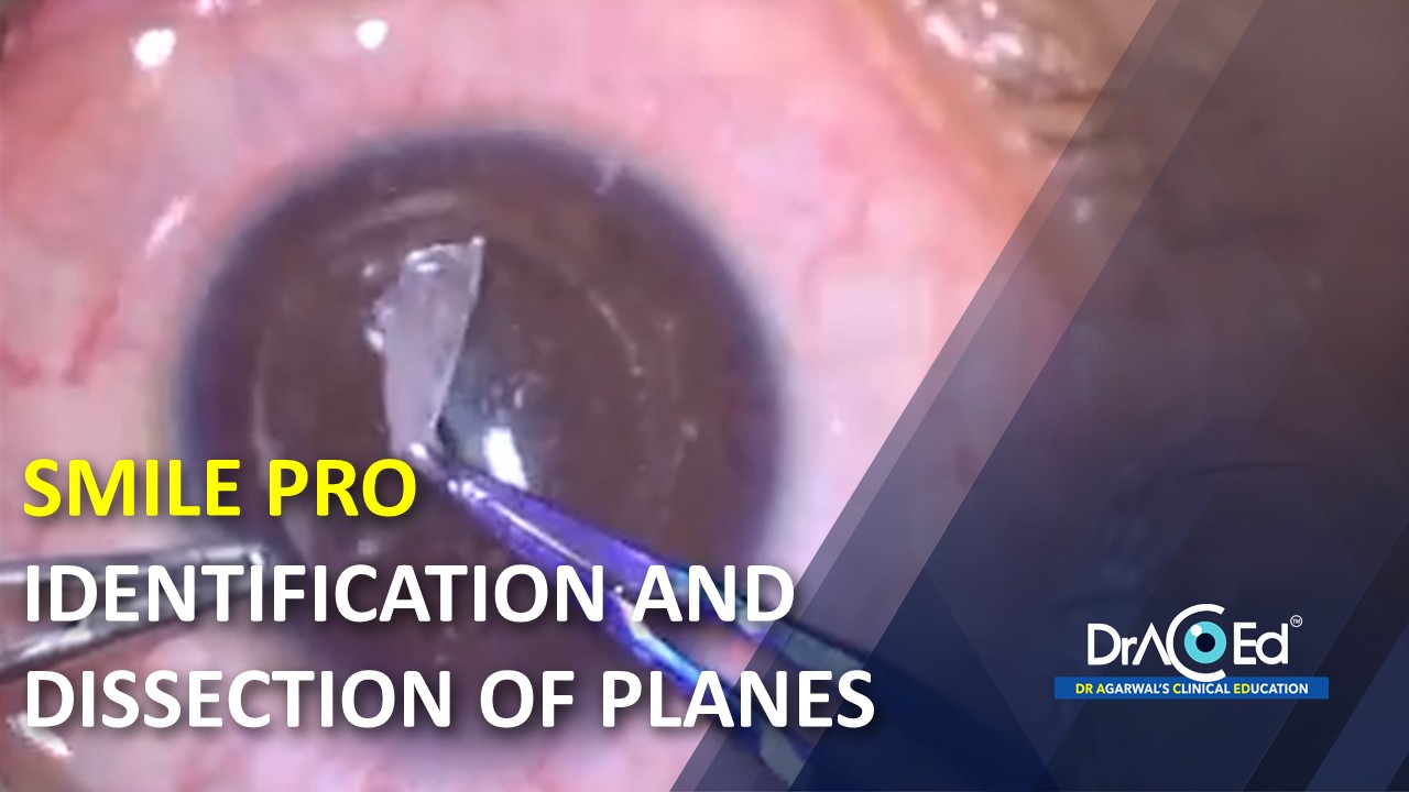 SMILE PRO - IDENTIFICATION AND DISSECTION OF PLANES
